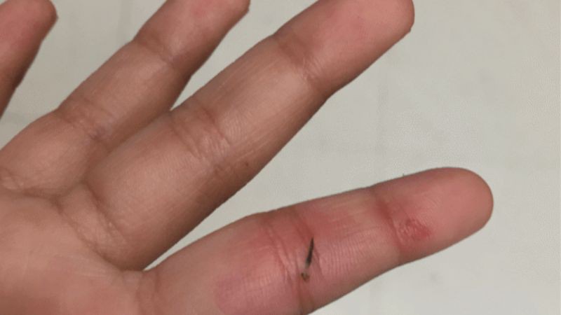 Trẻ bị dằm đâm