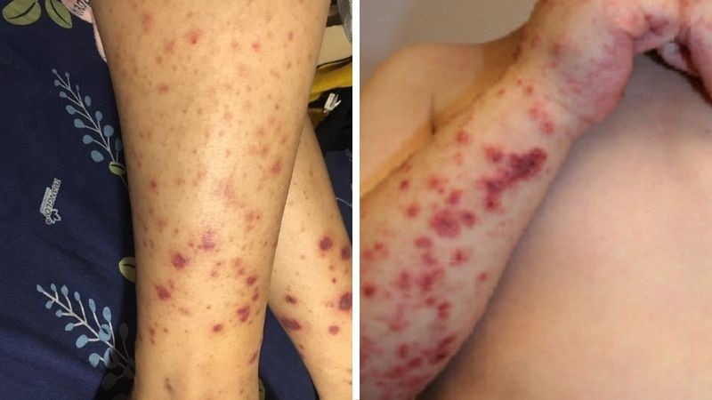 Bệnh viêm mạch do IgA là một dạng viêm mạch do ban xuất huyết Schonlein Henoch