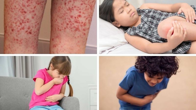 Triệu chứng của bệnh viêm mạch xuất huyết Schonlein Henoch