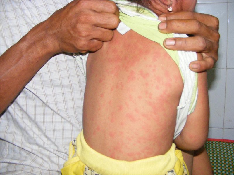 Cha mẹ nên làm gì để đề phòng bệnh sởi cho trẻ trong mùa đông xuân?